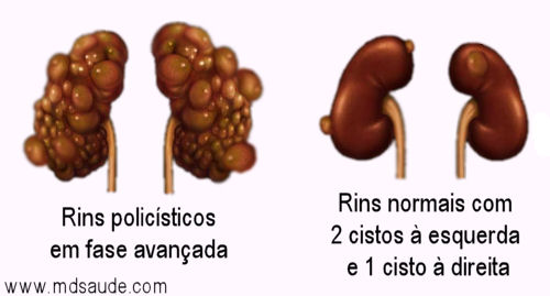 Diferença entre rins policísticos e rim com cisto simples