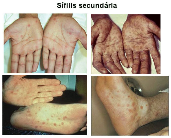 Sífilis secundária