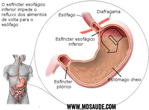 Refluxo gastroesofagico - DRGE