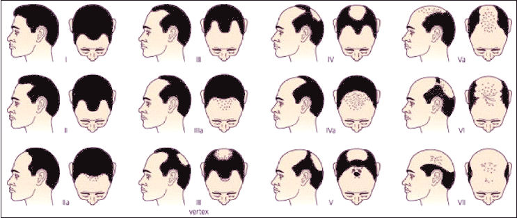 Calvície masculina