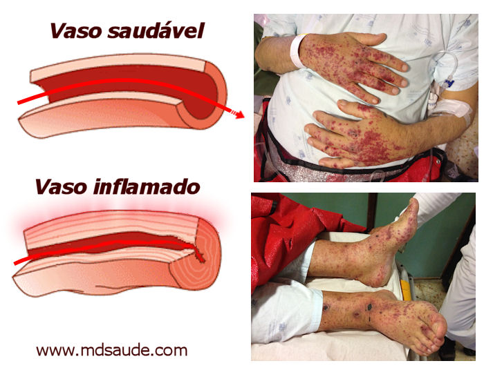 Vasculite de pés e mãos