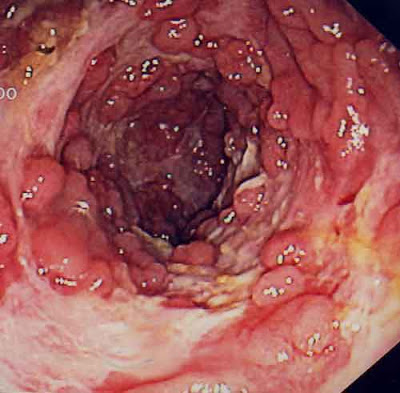 Doença de Crohn na colonoscopia