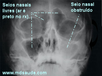 Sinusite na radiografia de seios da face