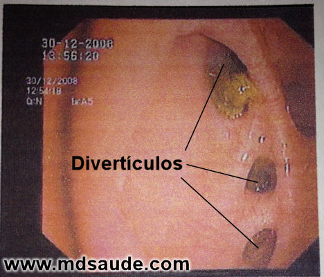 Divertículos