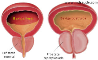 Hiperplasia prostática provocando obstrução da urina