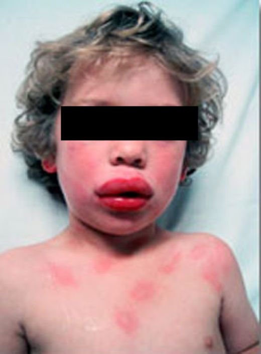 Angioedema e urticária