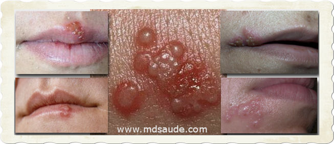 herpes labial