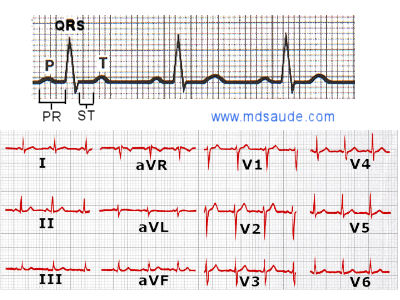Típico ECG
