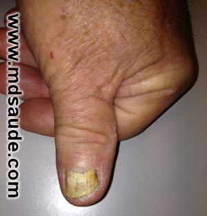 Onicomicosis