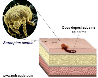 Escabiose - Sarcoptes scabiei na pele