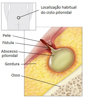 Formação do Cisto pilonidal