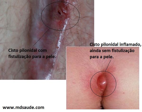 Foto de cisto pilonidal
