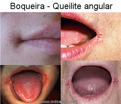 Boqueira - Queilite angular