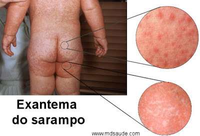 Sarampo