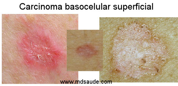 Carcinoma basocelular superficial