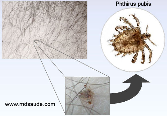 Chato - Phthirus pubis