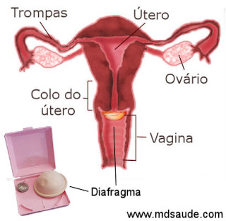 Método anticoncepcional: diafragma