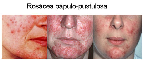 Rosácea pápulo-pustulosa