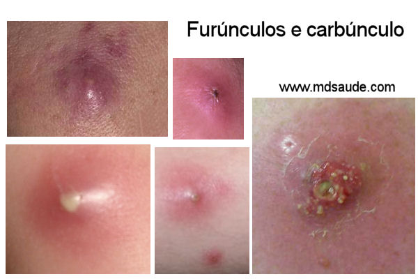 Foto de furúnculos