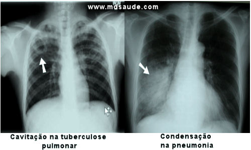 Pneumonia e tuberculose