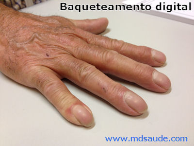 baqueteamento digital
