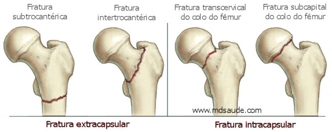 Tipos de fratura do quadril