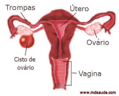 Cisto de ovário