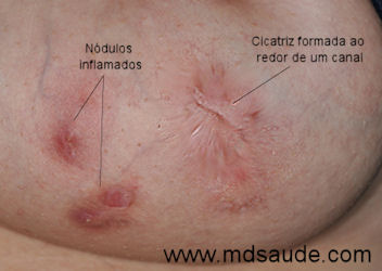 Foto de hidradenite
