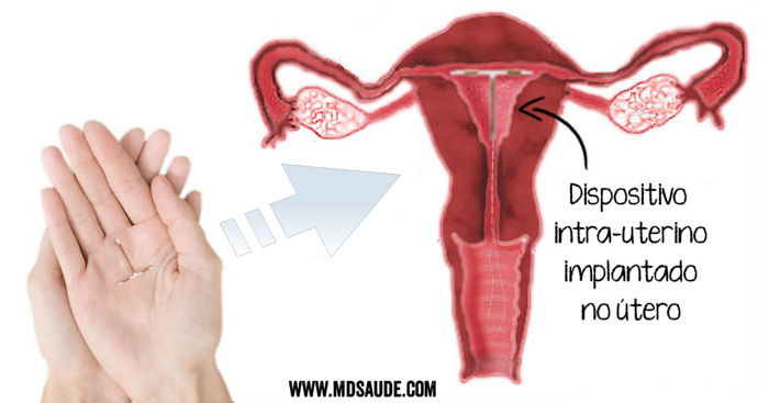 DIU implantado no útero