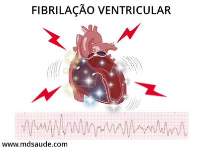 Fibrilação ventricular - morte súbita