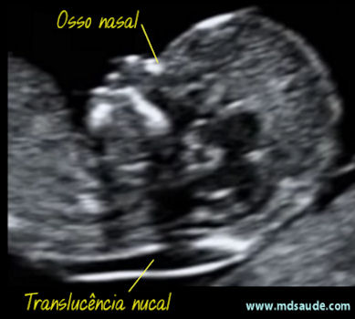 Transluscência nucal