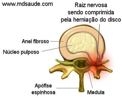 Hérnia de disco