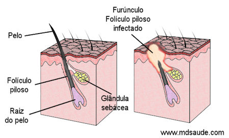 Como se forma um furúnculo