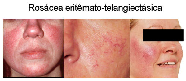 Rosácea eritêmato-telangiectásica
