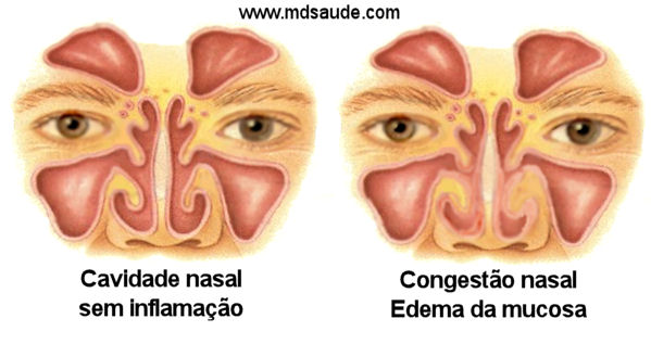 Nariz entupido