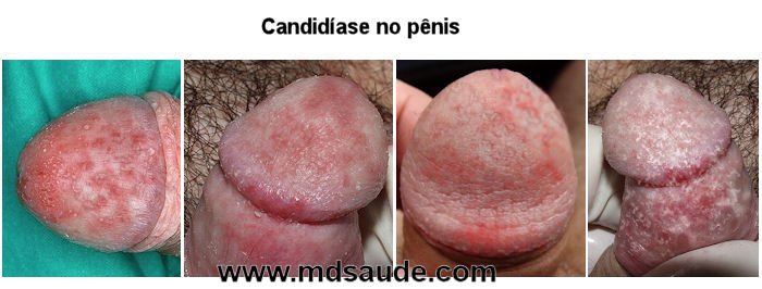 Fotos de Candidíase em homem