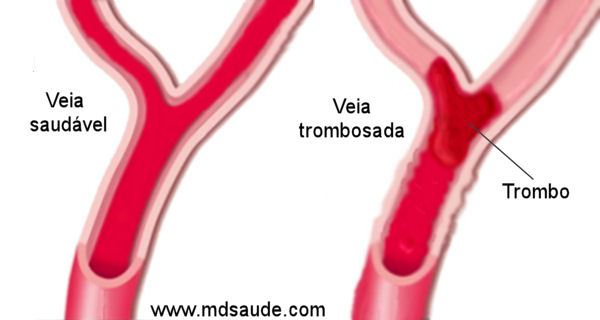 Imagem de trombose venosa