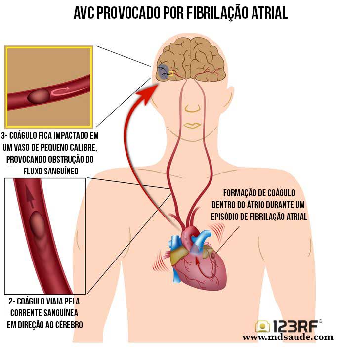 AVC embólico por fibrilação atrial