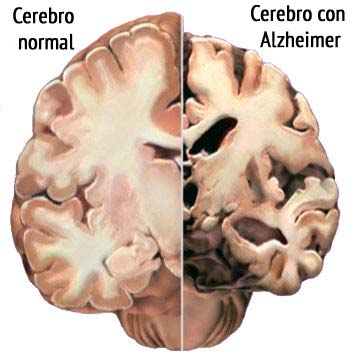 Alzheimer