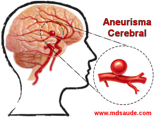 Aneurisma cerebral sacular