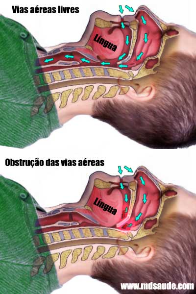 Vias áreas na apneia do sono.