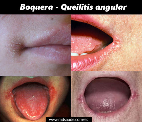 Queilitis angular