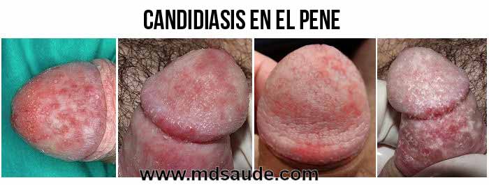 Fotos - Candidiasis en los hombres