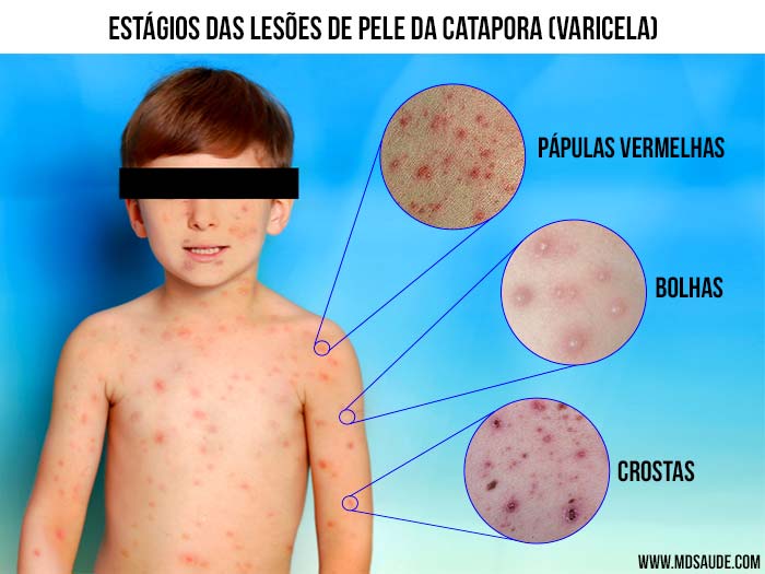 Lesões de pele da catapora