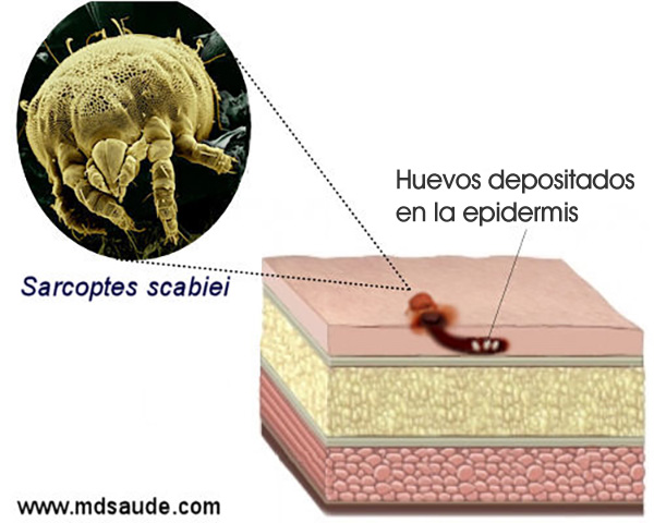 Sarcoptes scabiei