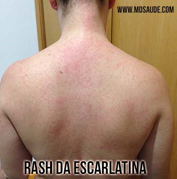 Rash da Escarlatina no tronco