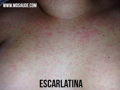 rash da Escarlatina