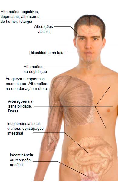 Lista de sintomas da esclerose múltipla