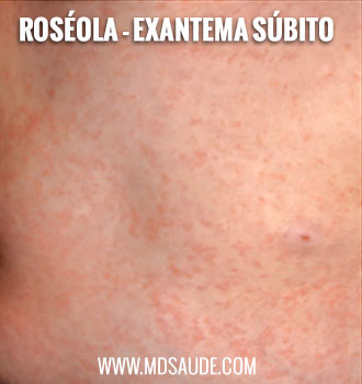 Rash da roséola
