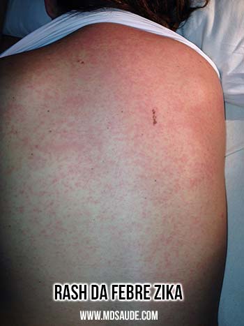 Rash febre zika